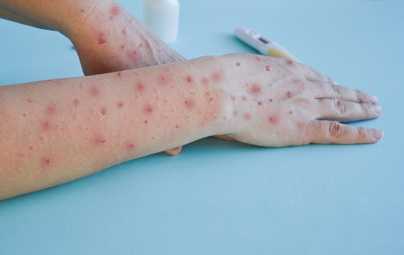 Académico de la UCM y la Viruela del Mono: “El uso de la mascarilla ayudará a que no se propague demasiado”