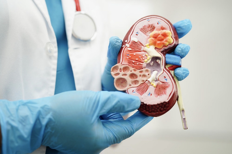 Cáncer de riñón: Advierten incremento de casos por envejecimiento poblacional
