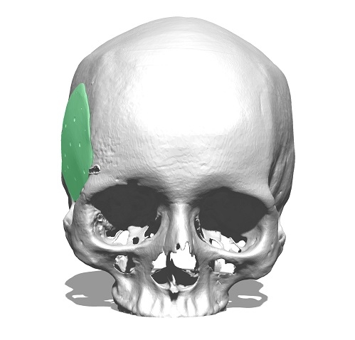 Startup chilena desarrolla implantes cráneo-faciales customizados con tecnología única