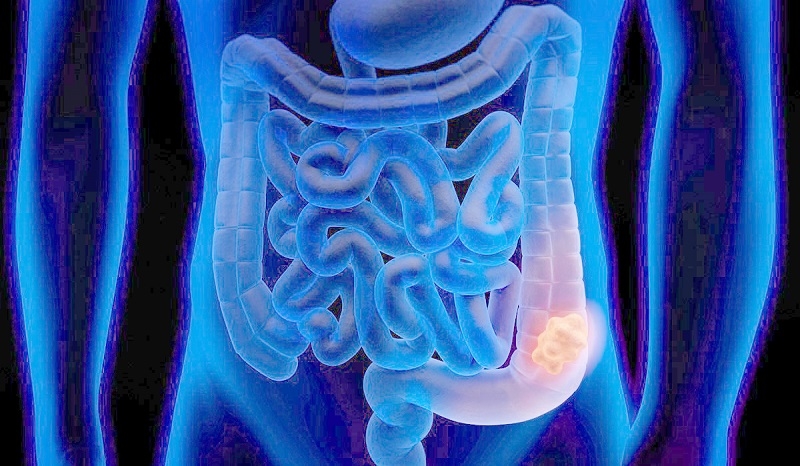 Especialistas comparten su preocupación por alza del cáncer de colon en personas menores de 50 años